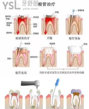 牙爛到什么程度要根管治療