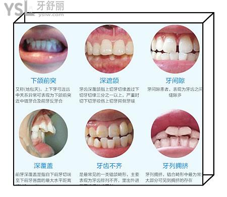 兒童牙齒矯正硅膠牙套品牌有哪些 改如何選擇呢.jpg