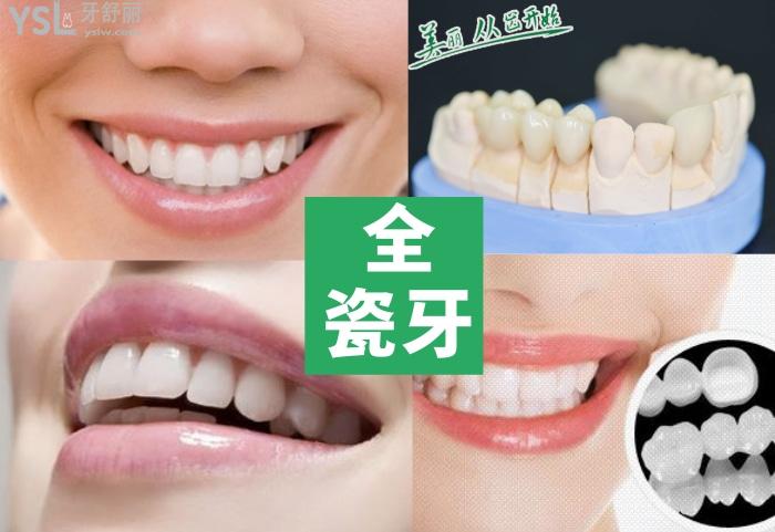 800元一顆是全瓷牙嗎 800元做一顆國產(chǎn)全瓷牙