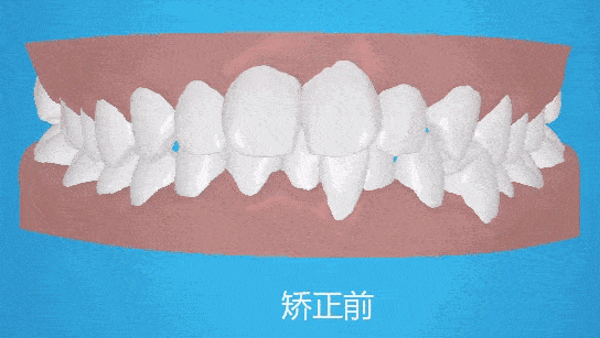 成年后骨性凸嘴可以改善嗎