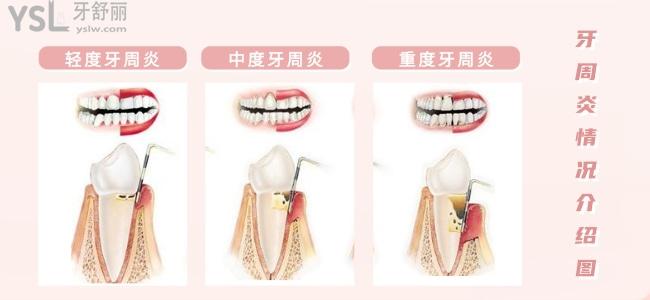 牙周炎情況介紹