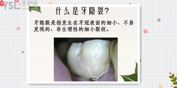 隱裂牙的主要癥狀有哪些 我們又該如何預(yù)防牙隱裂呢.png
