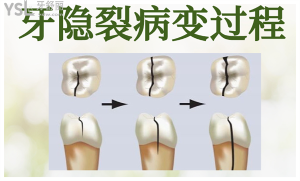 牙隱裂5.png