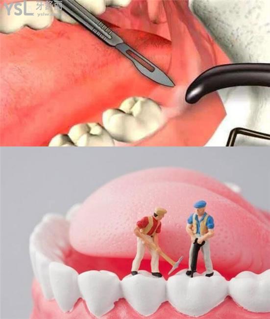 拔牙