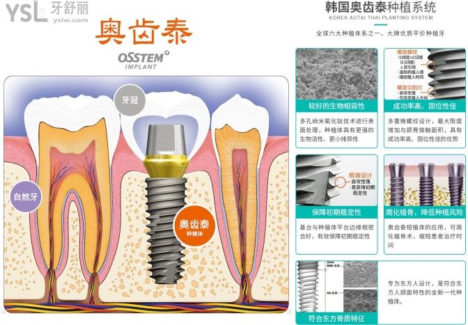 韓國奧齒泰種植牙壽命及價格
