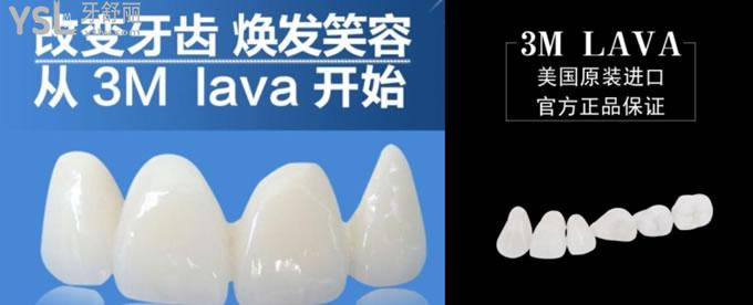 美國3m Lava全瓷牙