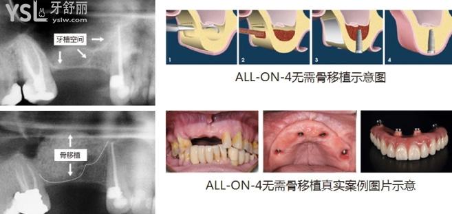 allon4即拔即種即刻負(fù)重