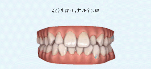 兒童早期矯正器的種類及價(jià)格公開