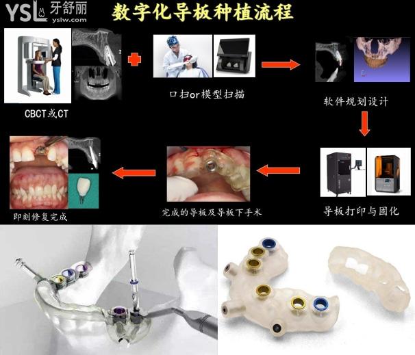什么是3d數(shù)字化導板種植牙，3d數(shù)字化導板種植牙的作用和費用