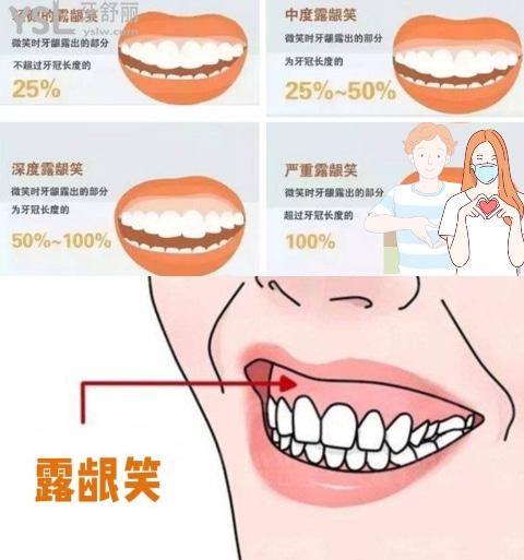 露齦笑矯正前后對(duì)比