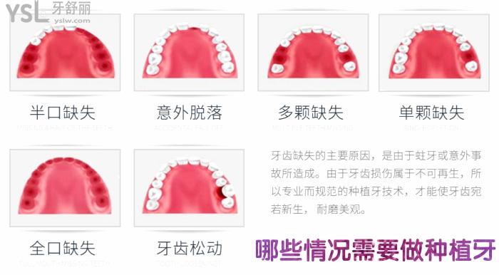 get新福州種植牙醫(yī)院排名！沒(méi)有BBQ只有哪家牙科醫(yī)院種植比較好！