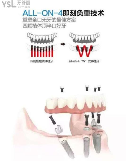 all-on-4半口即刻負重種植技術(shù)