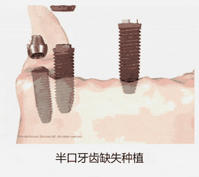 種植牙