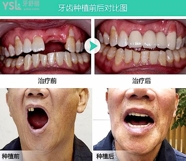 良心醫(yī)生不建議種植牙的緣由為什么，那建議用啥方法呢？
