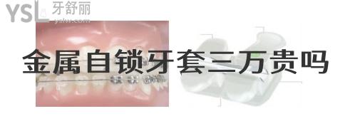 金屬自鎖牙套三萬(wàn)