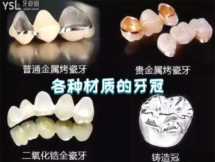 南京醫(yī)院可以做全瓷牙冠的有哪些？在南京烤瓷牙套一個(gè)多少錢呢？