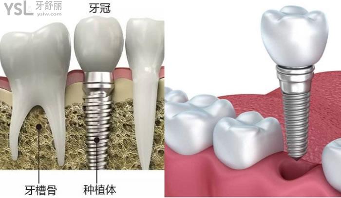 韶關(guān)矯正牙齒價(jià)格多少