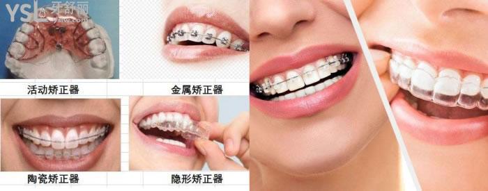 韶關(guān)矯正牙齒價(jià)格多少
