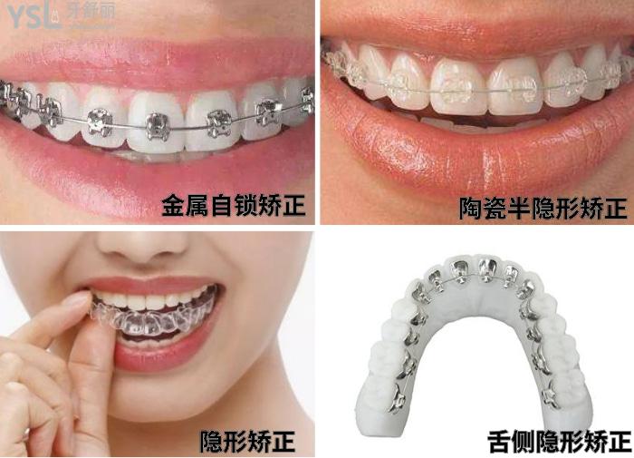 牙齒矯正.jpg