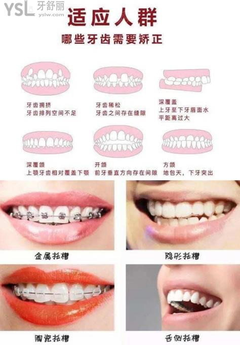 四種牙齒矯正方式