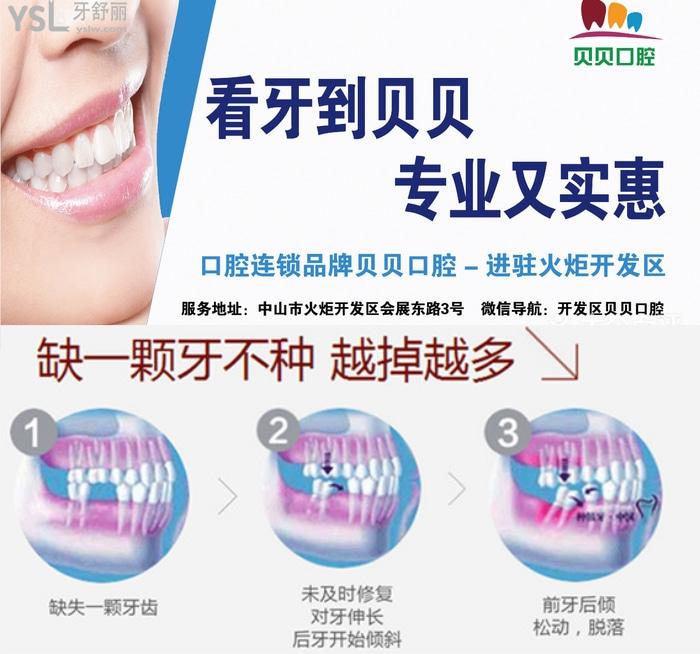 中山貝貝悅美口腔種植牙優(yōu)惠