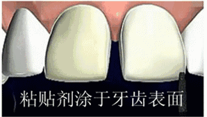 超模瓷貼面和全瓷貼面的區(qū)別是什么，牙貼面多少錢，牙貼面有什么后遺癥嗎