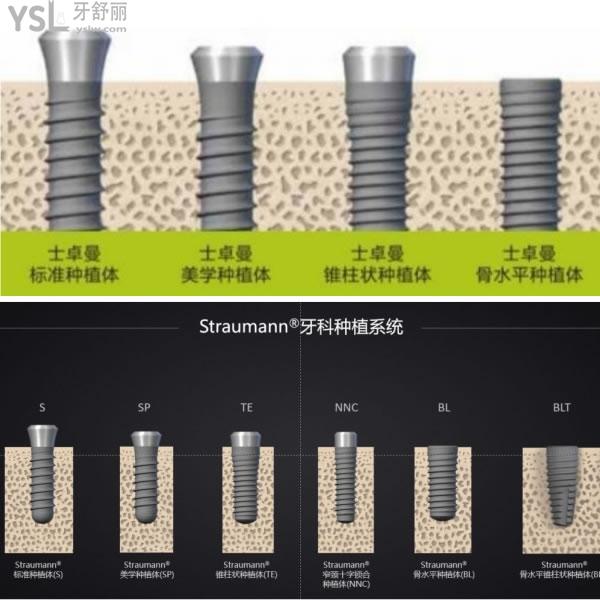 瑞士士卓曼(ITI)種植牙.jpg