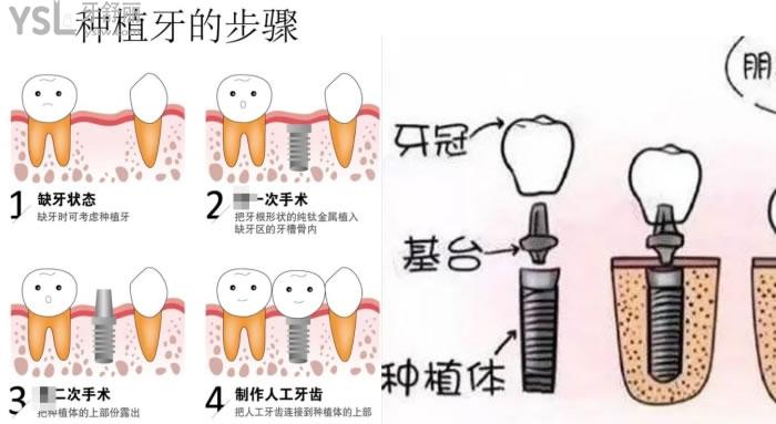 包頭義隆口腔種一顆牙多少錢