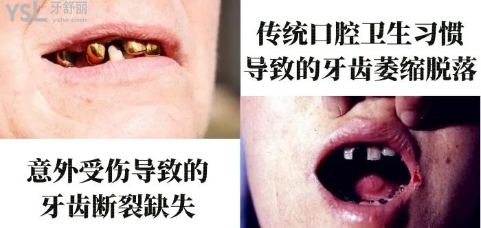 50歲做種植牙心酸歷程！種植牙6年后的真實感受100字親歷！