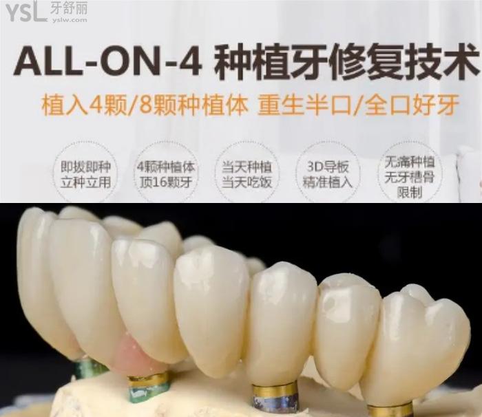 50歲做種植牙心酸歷程！種植牙6年后的真實感受100字親歷！