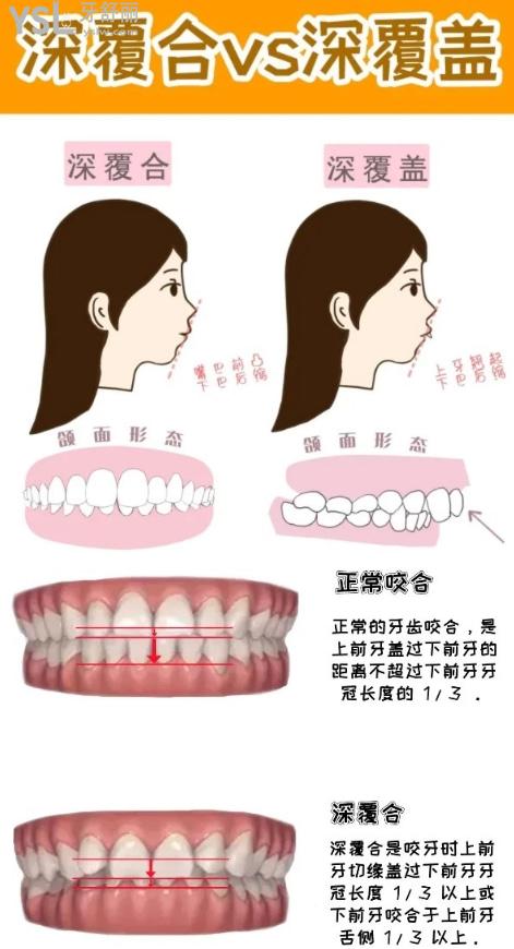 深覆合和深覆蓋的區(qū)別