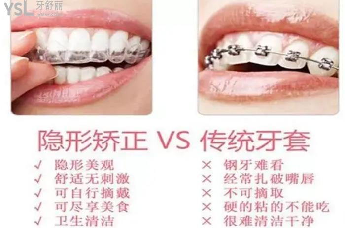 隱形矯正和金屬矯正哪個(gè)好？看好兩者區(qū)別做矯正事半功倍！
