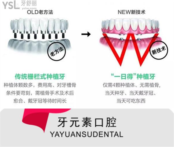 大連牙元素口腔種植牙特色