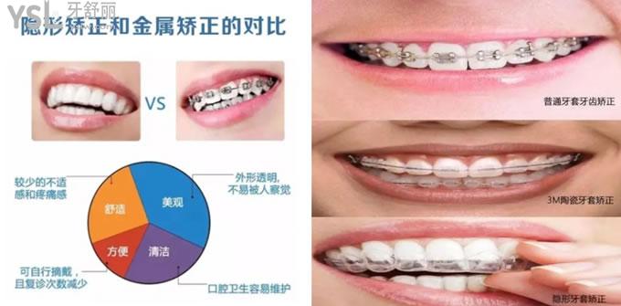 牙齒矯正對(duì)比