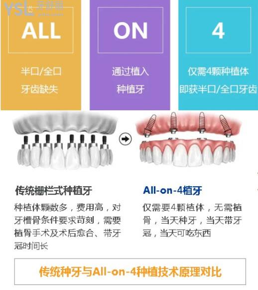 all-on-4種植牙優(yōu)勢