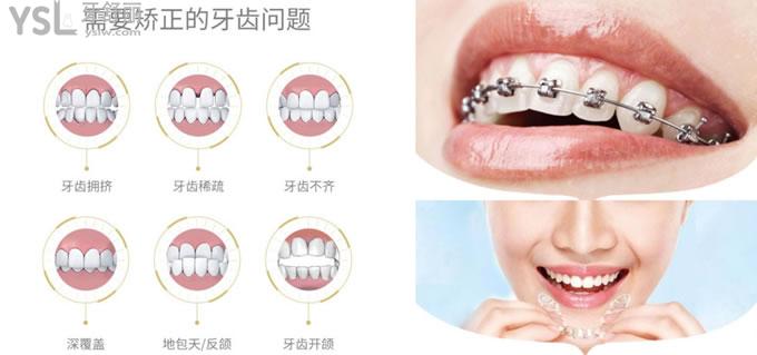 牙齒矯正圖