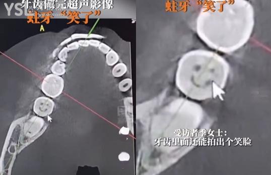廈門蛀牙去哪個醫(yī)院補牙好