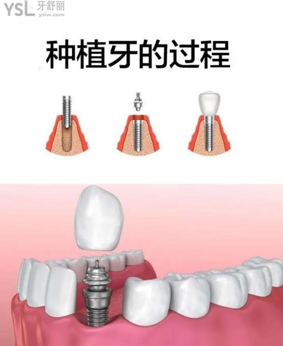 單顆種植牙