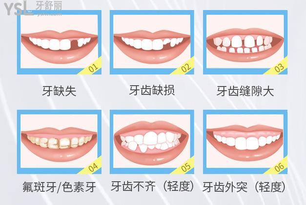 烤瓷牙適用于哪種情況呢