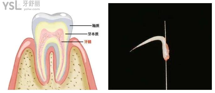 太后悔做根管治療！千萬不要隨便做 做完一顆牙齒就完了
