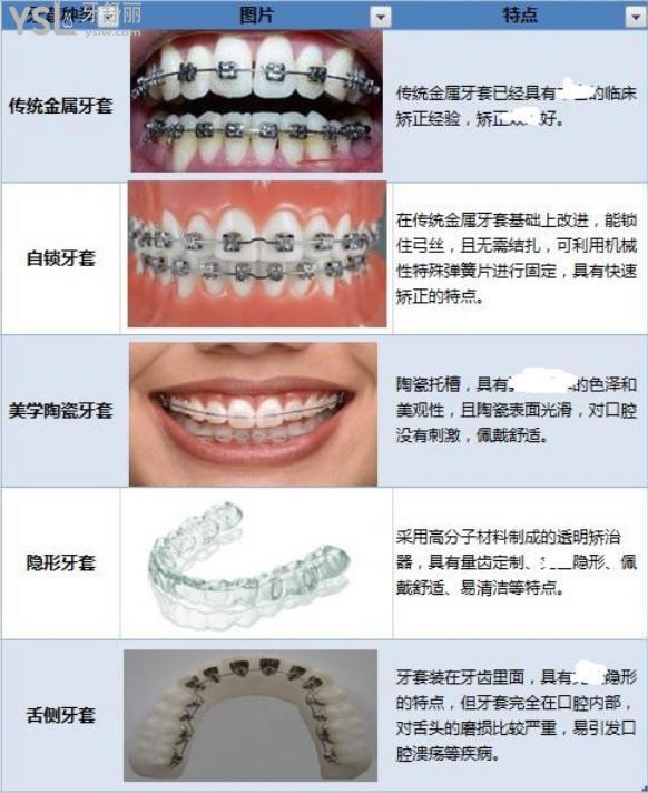 昆明隱形牙套矯正價格表