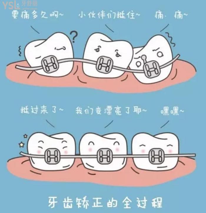 昆明隱形牙套矯正價格表