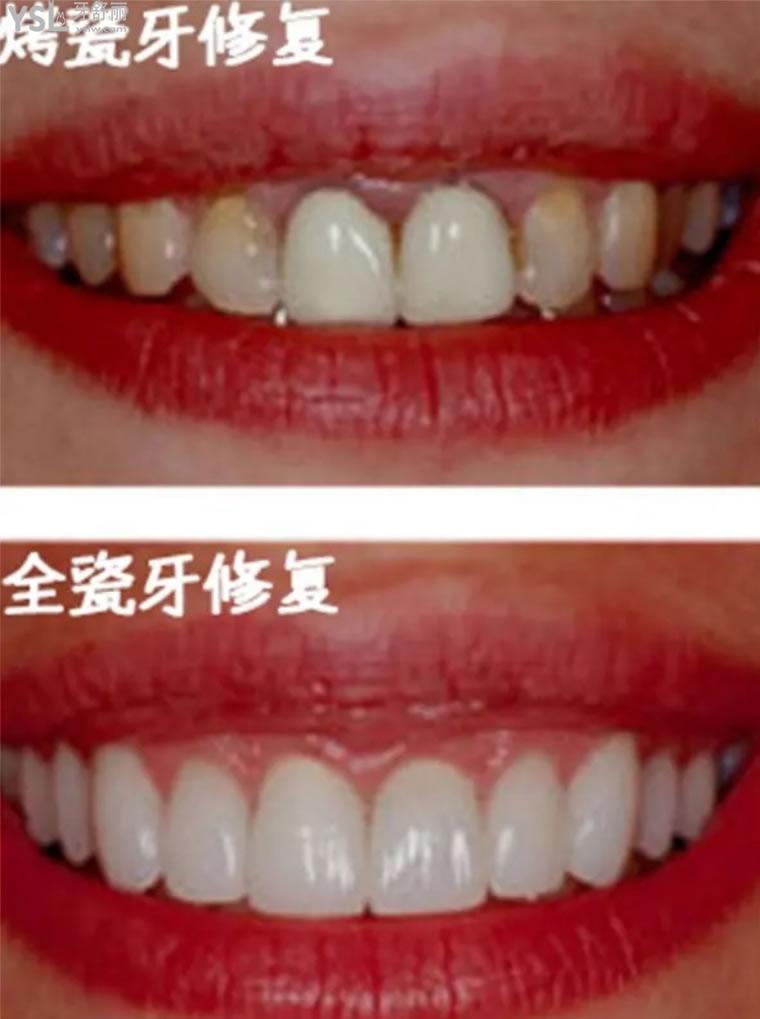 昆明做全瓷牙多少錢(qián)一顆