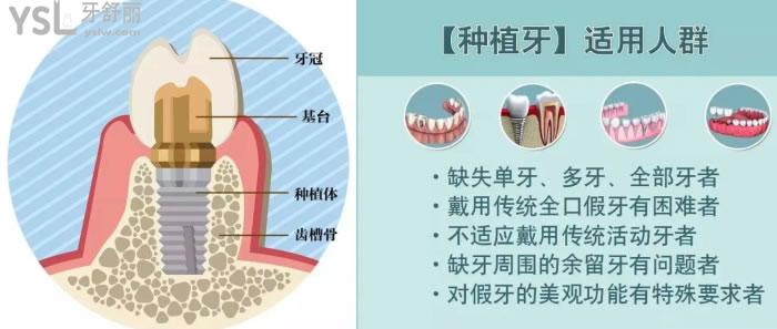 無錫種植牙多少錢一顆