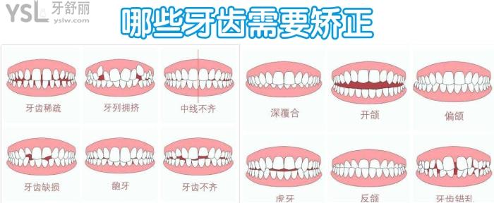哪些牙齒需要矯正
