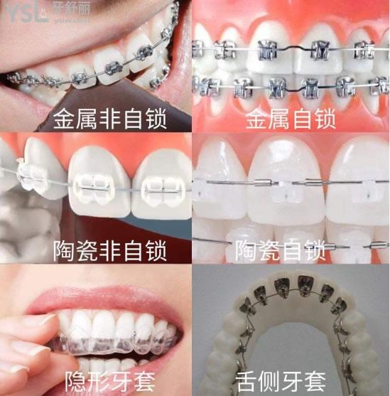 西安隱形牙套費(fèi)用大概多少