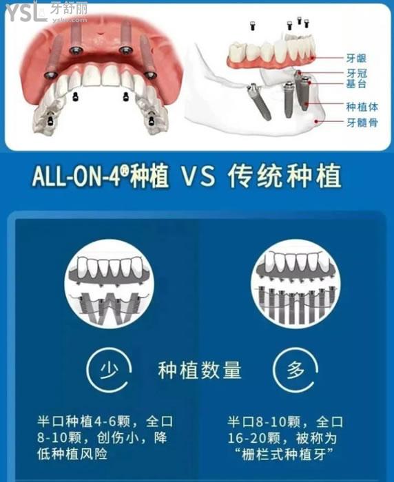 all-on-4種植技術(shù)與傳統(tǒng)種植對(duì)比