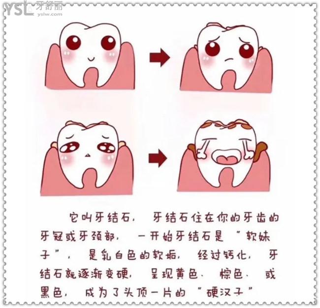 牙結(jié)石