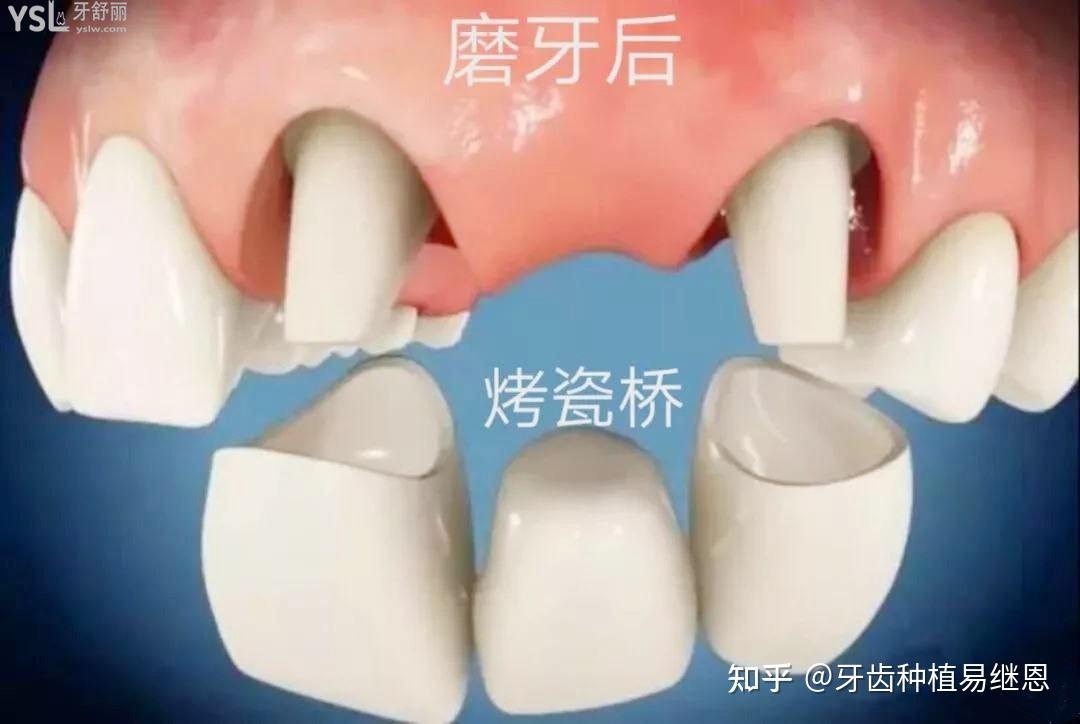 鑲牙