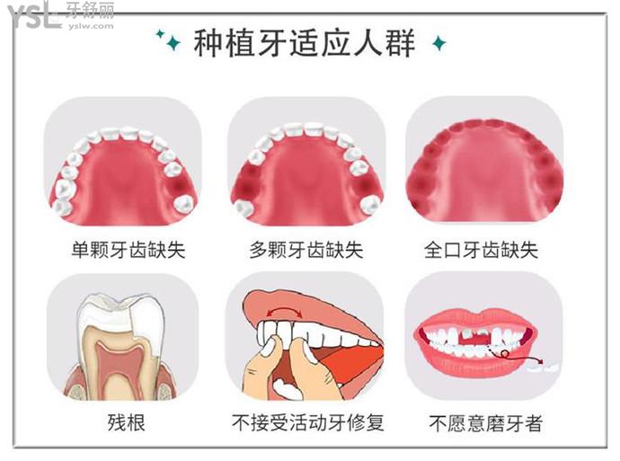 牙齒什么情況下需要種牙